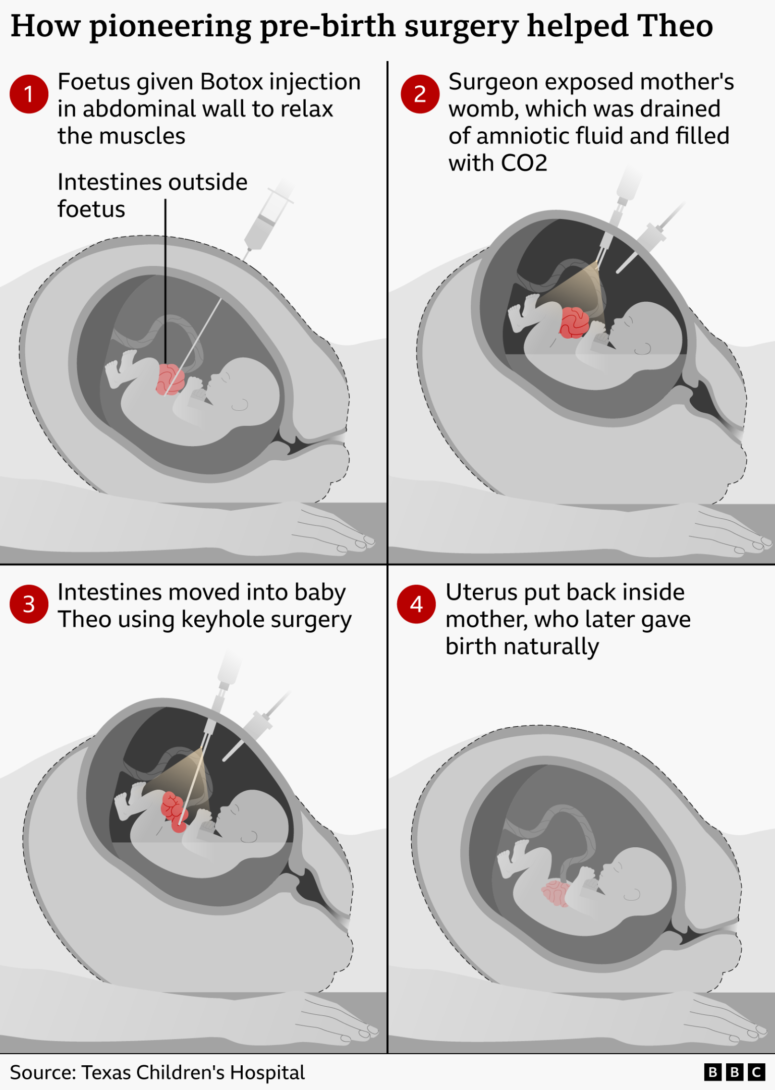 Woman has pioneering womb surgery to fix 'miracle' baby with intestines outside its body