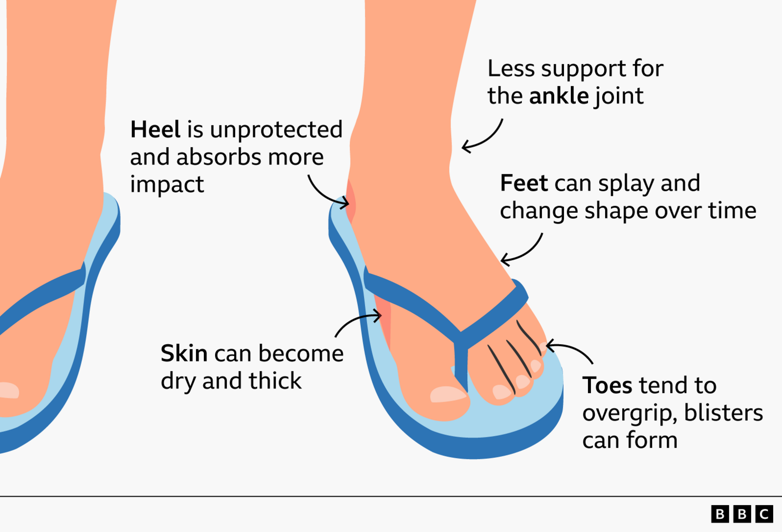 Are summer sandals killing your feet?